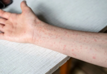 Emite OPS alerta epidemiológica por sarampión; México a la alza