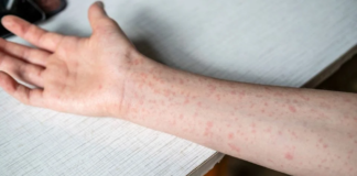 Emite OPS alerta epidemiológica por sarampión; México a la alza