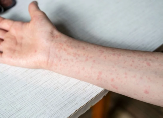 Emite OPS alerta epidemiológica por sarampión; México a la alza