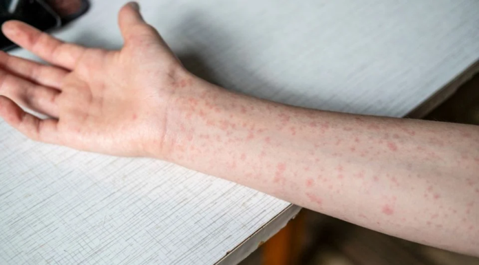 Emite OPS alerta epidemiológica por sarampión; México a la alza